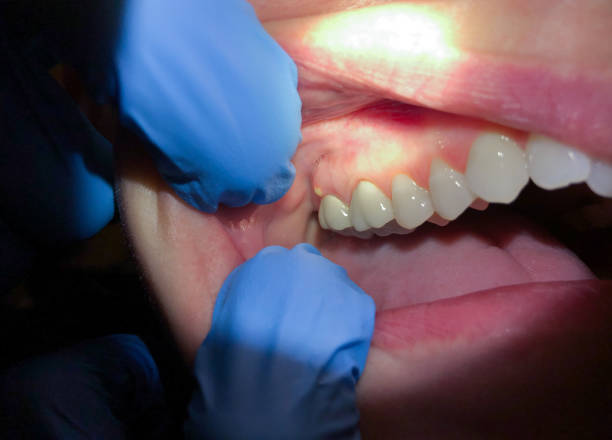Best Emergency Dental Care for Abscessed Tooth in East Shoreham, NY